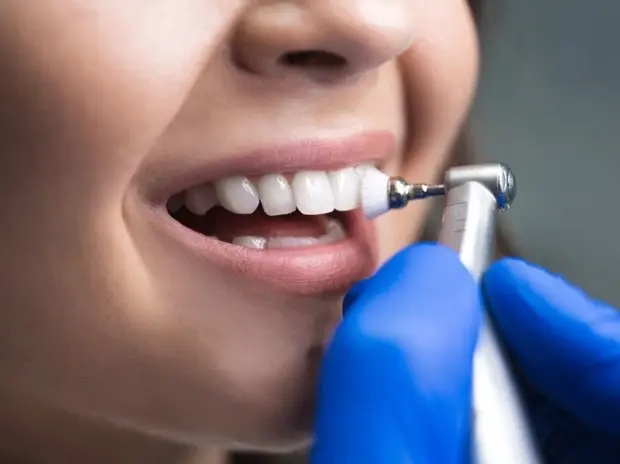 Teeth Polishing