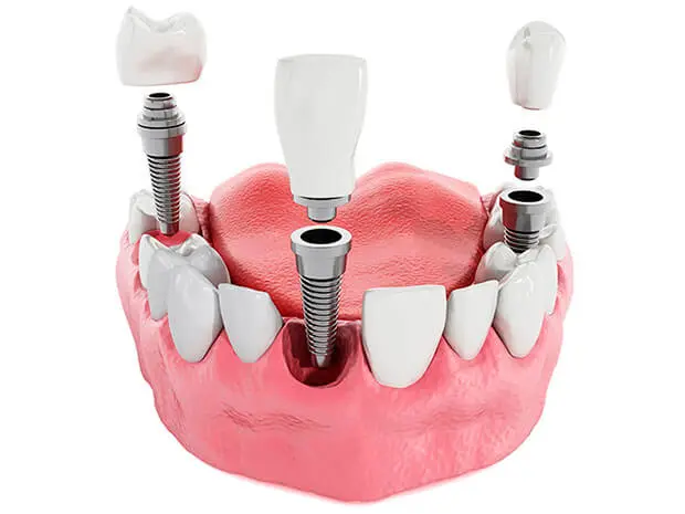 Dental Implants
