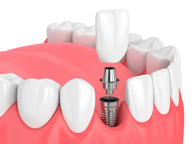 Immediate Implantation