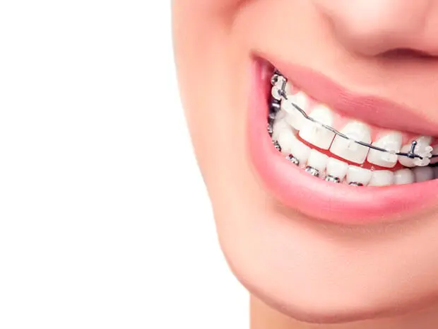 Orthodontic Braces System