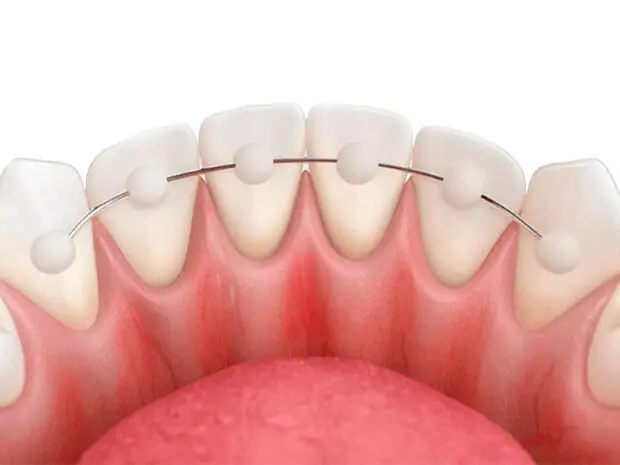 Orthodontic Retainers