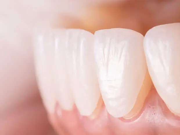 Dental Veneers