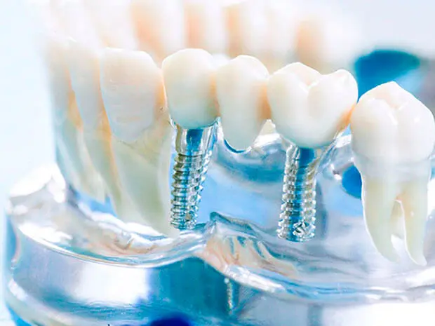 Implant-supported Prosthetics